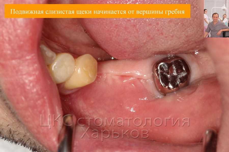 Результаты санации зубов