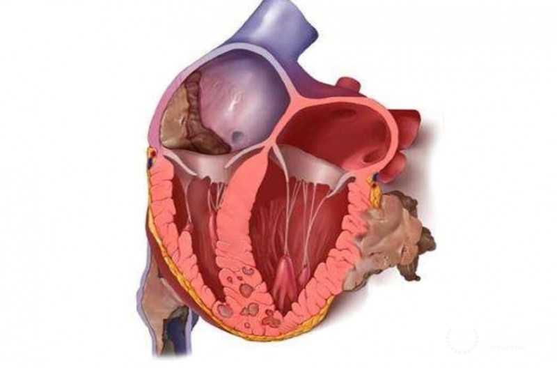 Прогноз и осложнения при саркоме сердца