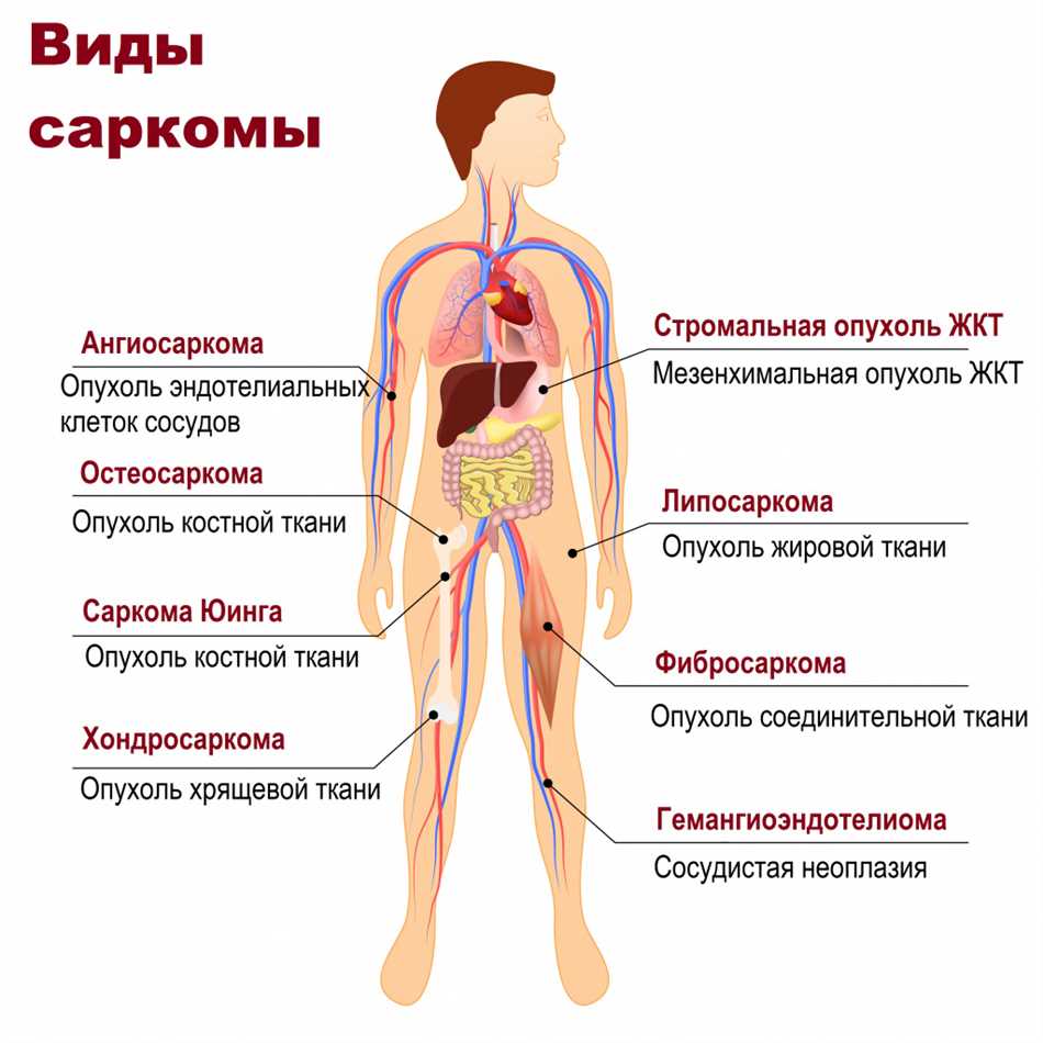 Диагностика саркомы Юинга голени