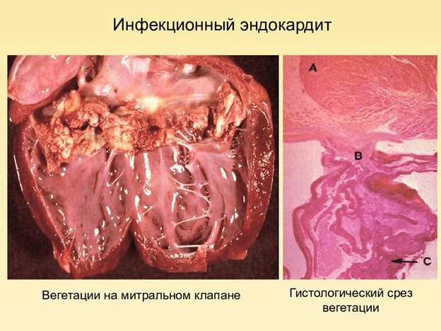 Диагностика септического эндокардита