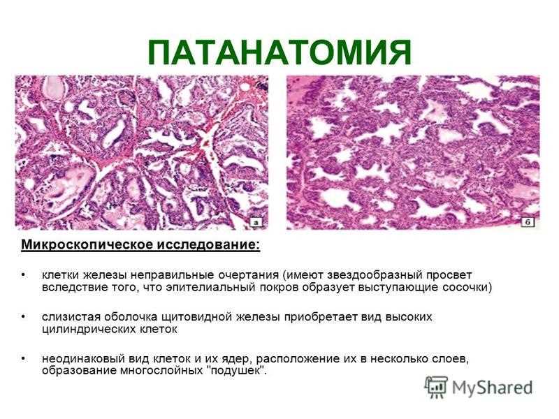 Причины возникновения септического эндокардита