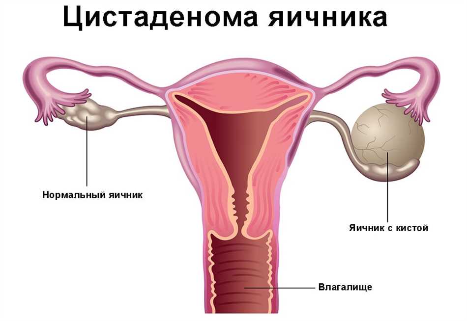 Диагностика серозной кисты левого яичника