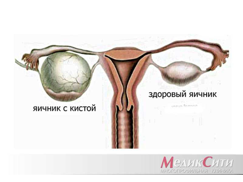 Что такое серозная киста левого яичника