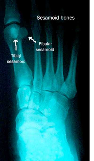 Что такое сесамовидная кость на стопе