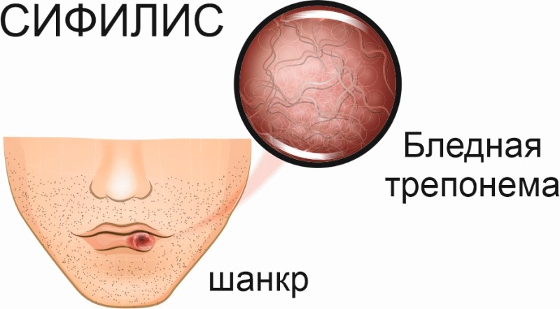 Осложнения сифилиса