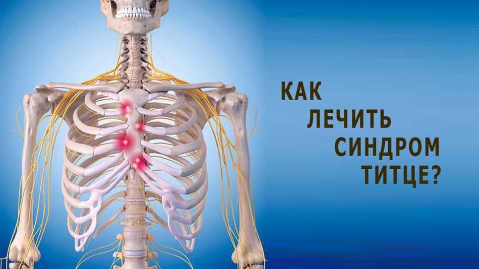 Что такое синдром Титце