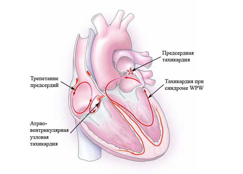 Причины и факторы развития синдрома ВПВ сердца