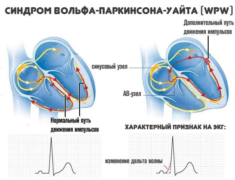 Симптомы и проявления синдрома ВПВ сердца