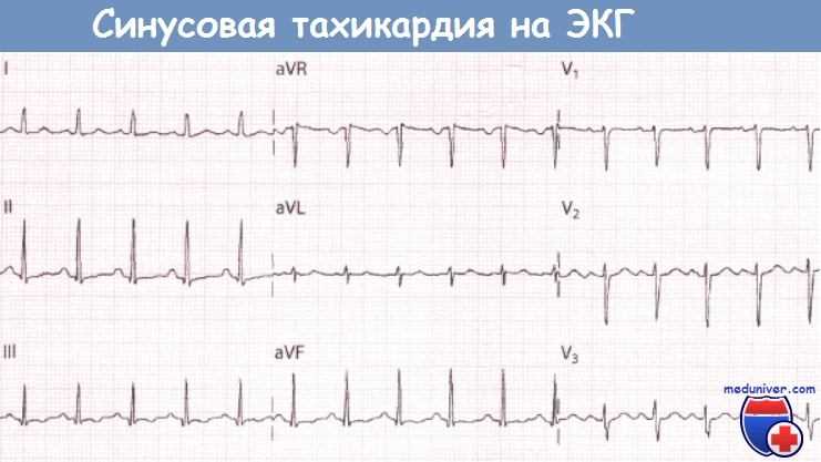 Что такое синусовая тахиаритмия?