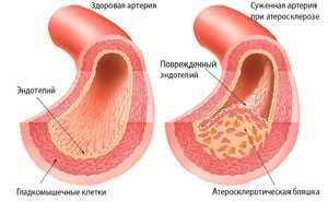 Атеросклероз и его влияние на аорту