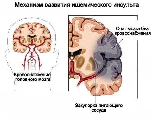 Симптомы склероза сосудов головы и шеи