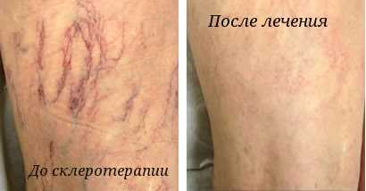 Послеоперационный период