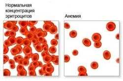 Что такое скрытая анемия при нормальном гемоглобине