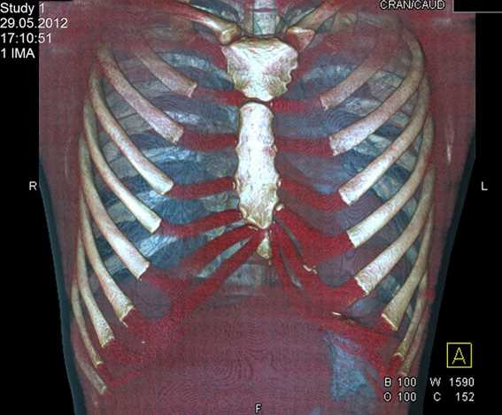 Преимущества и риски СКТ грудной клетки