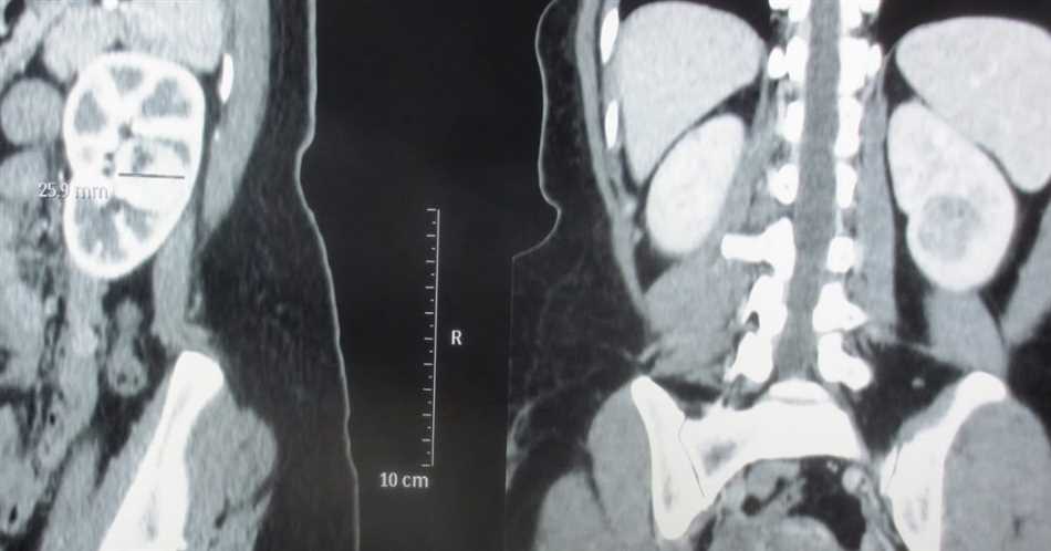 Как проходит процедура СКТ в медицине почек?