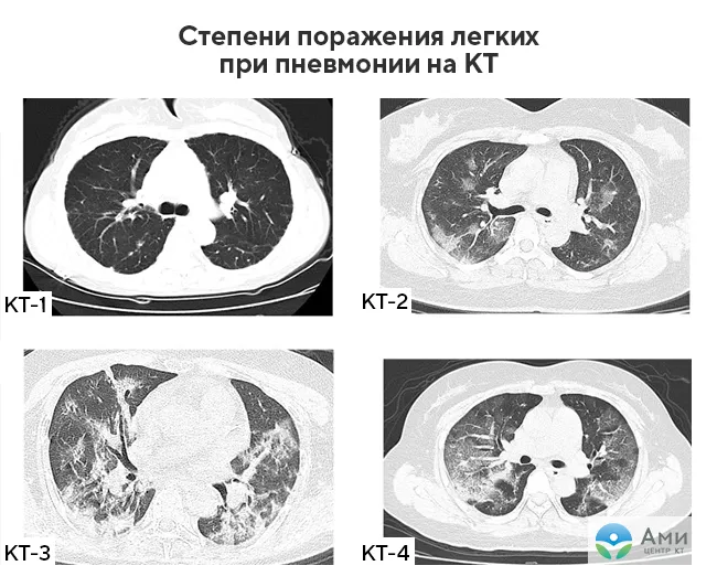 Кашель: неприятный спутник индурации легких