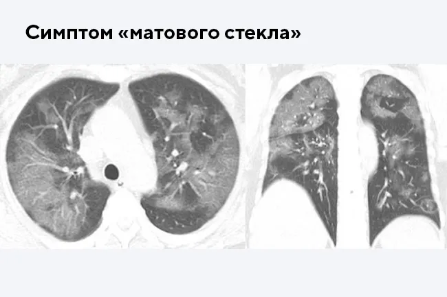 Причины индурации легких при коронавирусе