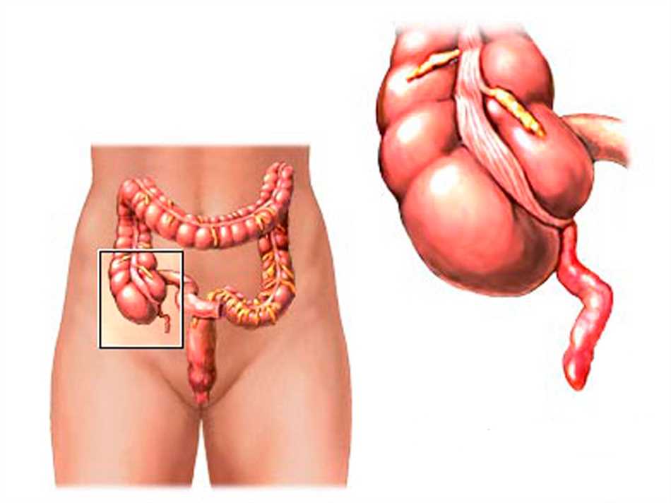 Профилактика инфильтрата брюшной полости после полостной операции