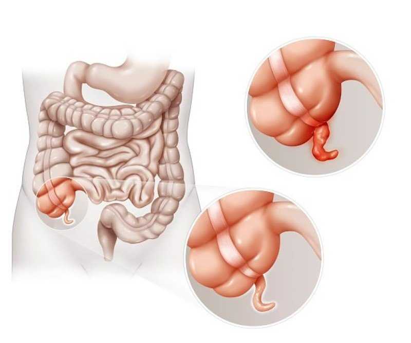 Последствия инфильтрата брюшной полости после полостной операции