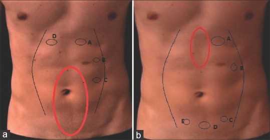 Симптомы инфильтрата брюшной полости после полостной операции