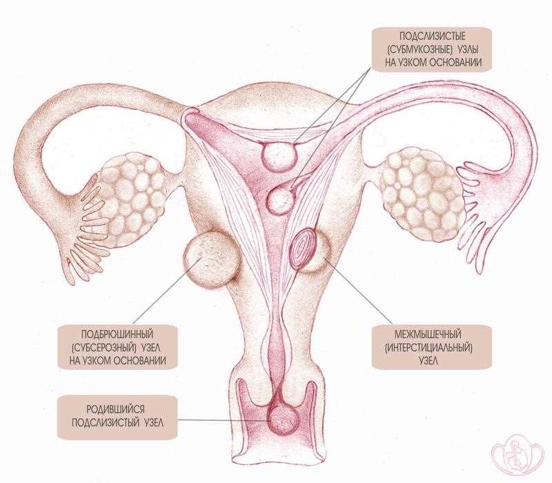 Методы исследования и лечения интерстициального узла матки