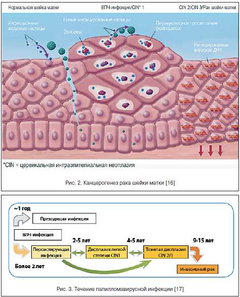 Диагностика и лечение интраэпителиальной неоплазии высокой степени