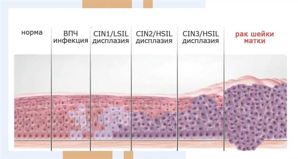 Причины развития интраэпителиальной неоплазии высокой степени