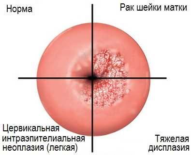 Интраэпителиальная неоплазия высокой степени: причины, симптомы, диагностика и лечение