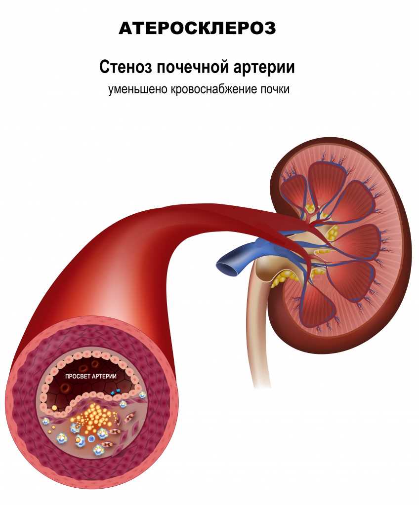 Лечение кальциноза сосудов зависит от степени и места поражения. Оно может включать следующие методы: