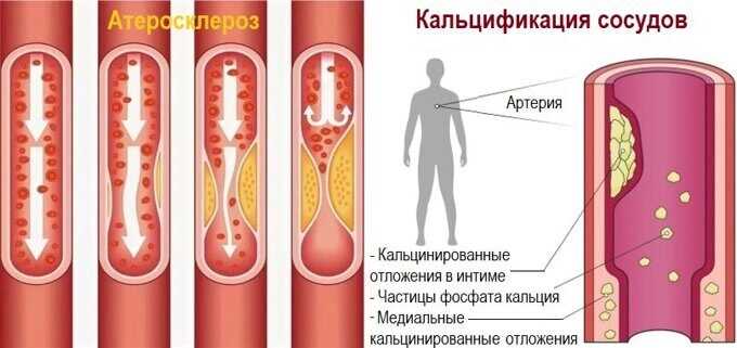 Кальциноз сосудов: причины, симптомы и лечение