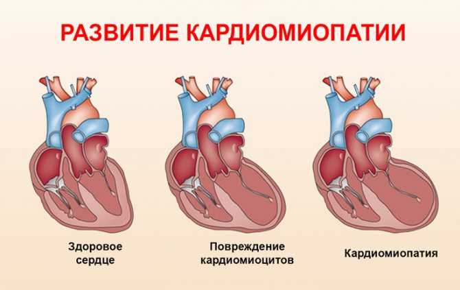 Лечение кардиопатии алкогольной