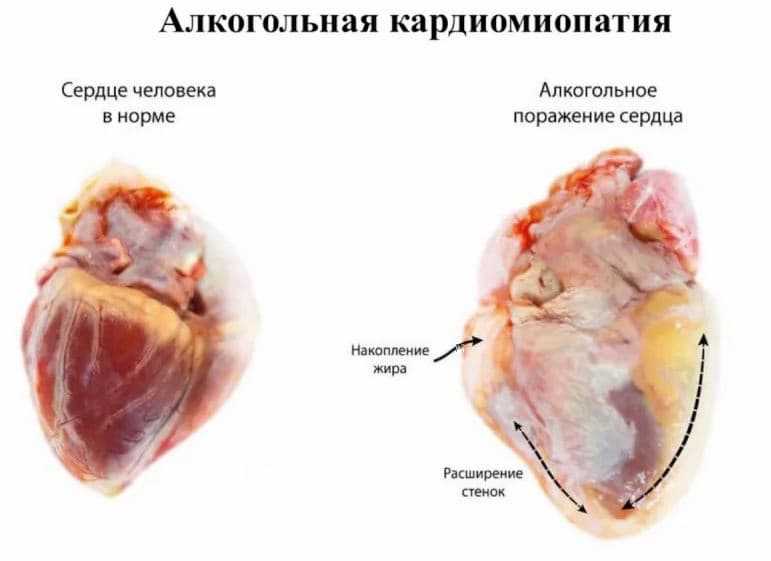 Диагностика кардиопатии алкогольной