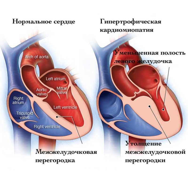 Одышка