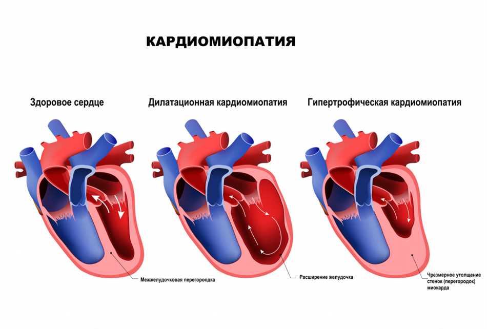 Кардиопатия сердца у взрослых: симптомы и проявления