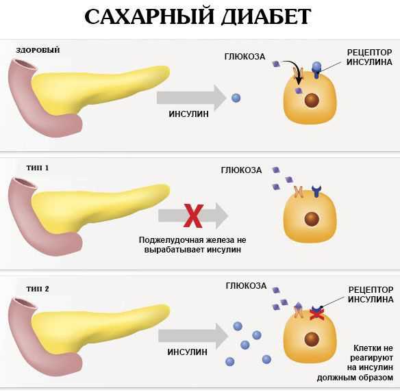 Симптомы кетоза при сахарном диабете: