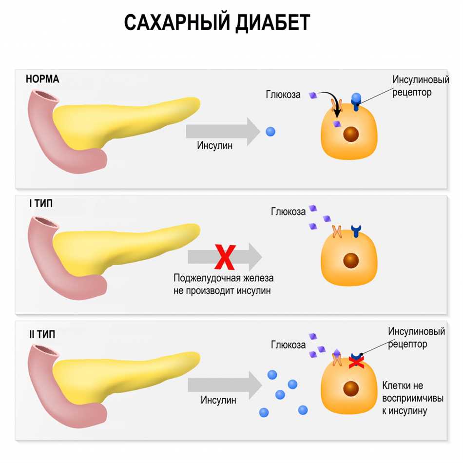 Симптомы кетоза при сахарном диабете