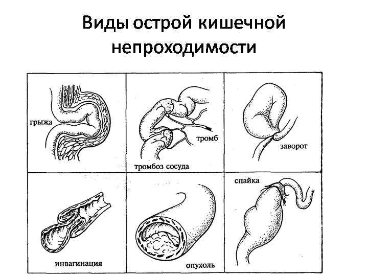 Кишечная непроходимость у новорожденных: симптомы и причины