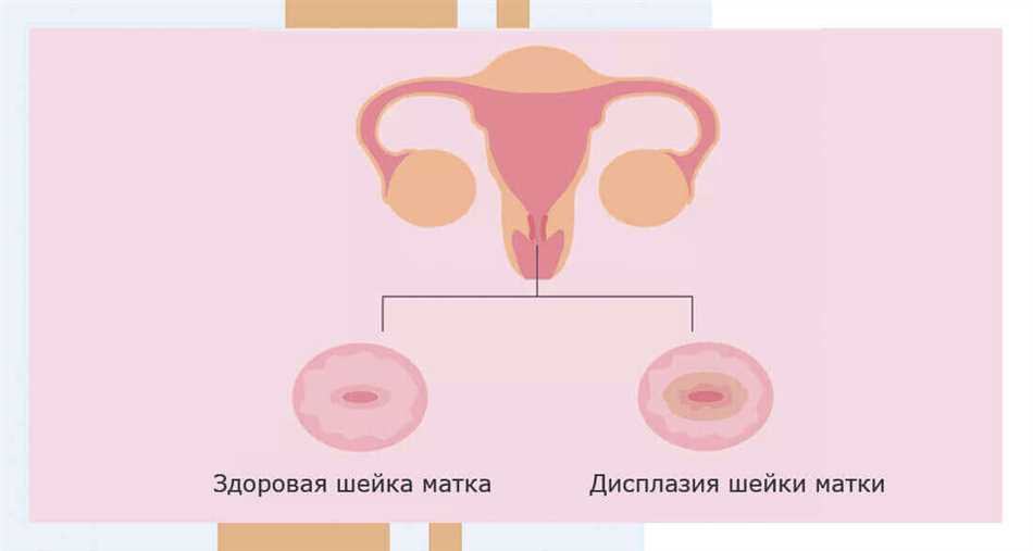 Койлоциты в гинекологии: причины, диагностика и лечение