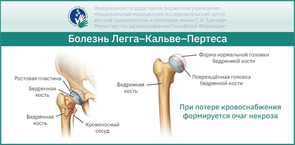 Костный секвестр: определение и причины возникновения