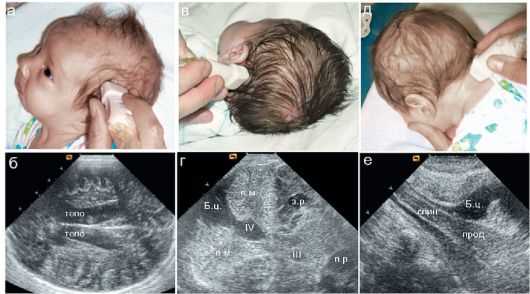 Симптомы легкой асимметрии боковых желудочков головного мозга у младенца