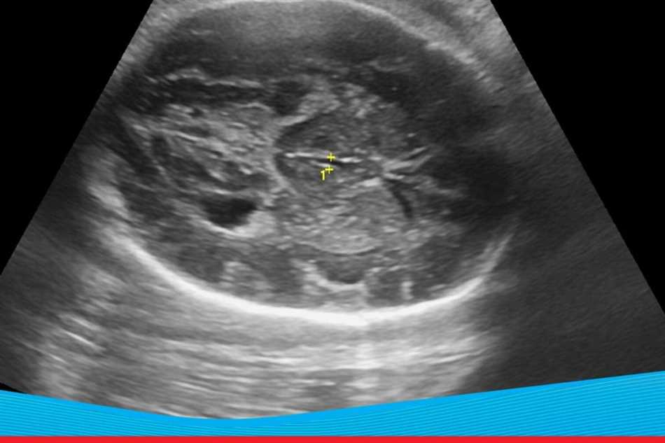 Легкая асимметрия боковых желудочков головного мозга у младенца