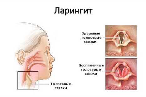 Лейкокератоз гортани: симптомы, причины и лечение