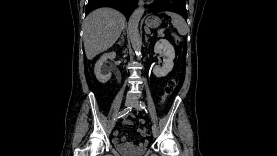 МСКТ почек с контрастированием: основные принципы и процедура