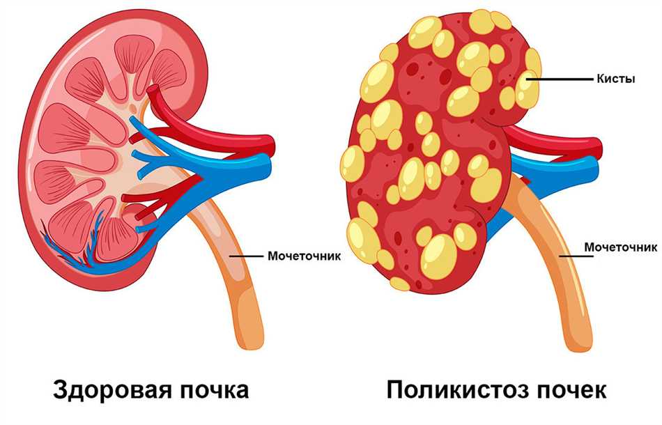 Причины развития мультикистоза почек