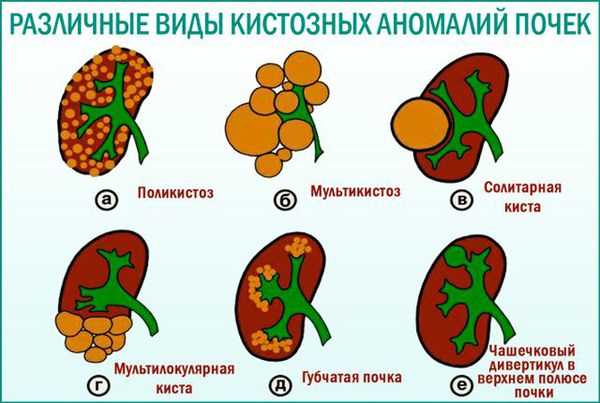 Симптомы мультикистоза почек