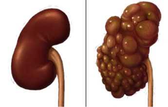 Мультикистоз почки: причины, симптомы и лечение