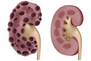 Мультикистоз почки: причины, симптомы и лечение