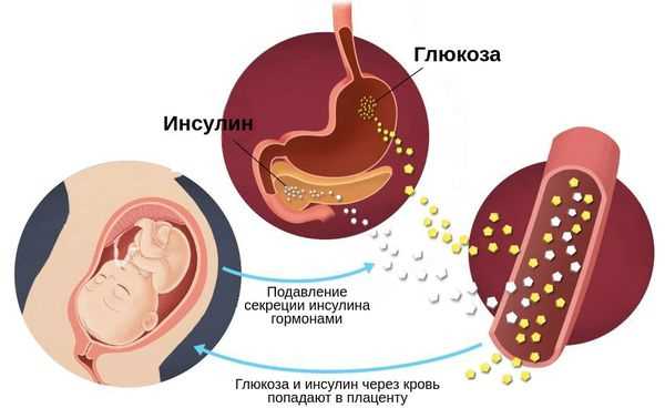 Нарушение толерантности к глюкозе у беременных: причины, признаки и лечение