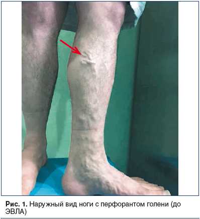 Несостоятельные перфорантные вены голени: причины, симптомы, лечение