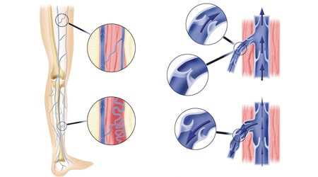 Несостоятельные перфорантные вены голени: причины, симптомы, лечение